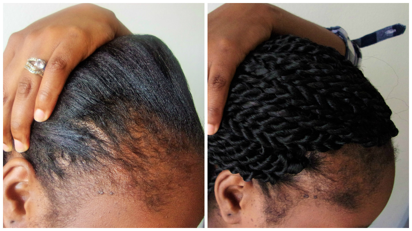 90 Day Castor Oil Challenge One Month Update